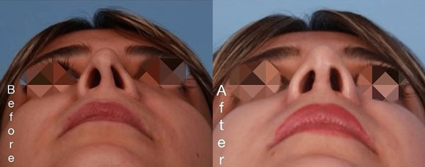 نمونه کار جراحی بینی ترمیمی _ دکتر محمد نعیمی