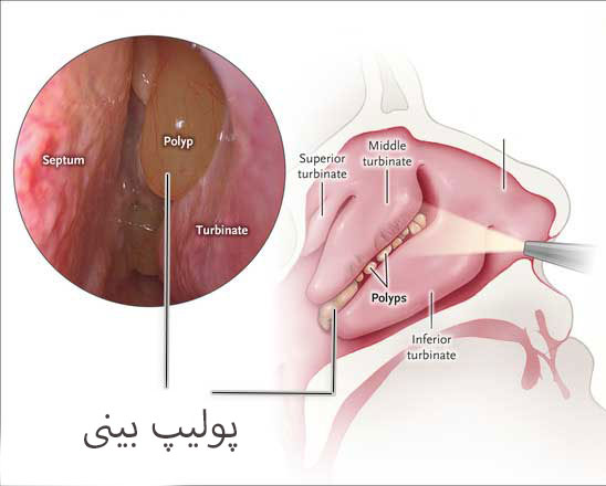 جراحی پولیپ بینی در مشهد _ دکتر محمد نعیمی