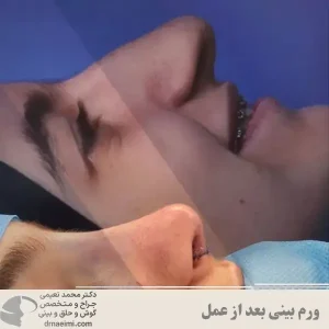 ورم بینی بعد از عمل _ دکتر محمد نعیمی