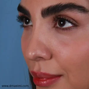 جراحی بینی استخوانی در مشهد _ دکتر محمد نعیمی