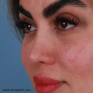 جراحی بینی استخوانی در مشهد _ دکتر محمد نعیمی