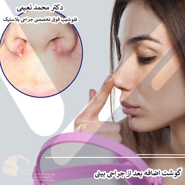گوشت اضافه بعد از جراحی بینی
