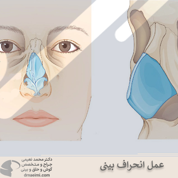 عمل انحراف بینی _ دکتر محمد نعیمی