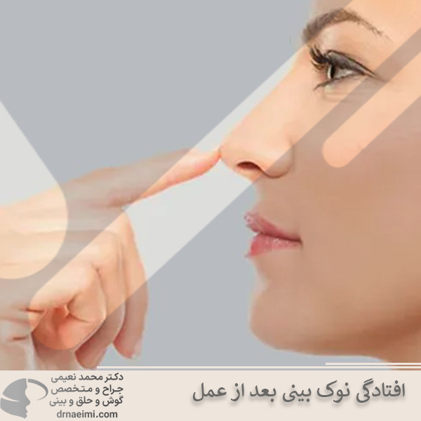 افتادگی نوک بینی بعد ازعمل _ دکتر محمد نعیمی